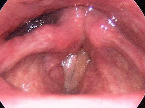 Паралич голосовых связок после операции